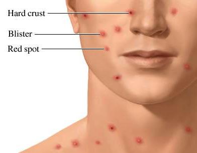 Common Diseases Chicken Pox Airborne; Lesion Contact 11-21 Days Mask; Gloves; Hand washing Fever (usually lasts 2-4