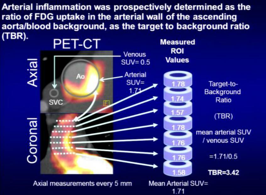 Direct proof of aortic inflammation in