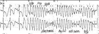Torsade de pointes: QT prolongation Treatment for Ventricular Tachycardia IV Amiodarone: 5-10 mg/kg bolus by 1-2 mg/kg slow push over 5 minutes, repeat q10-20 minutes 10 mg/kg/day IV infusion x 4-14