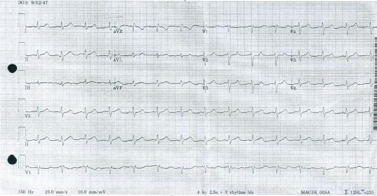 Artifacts Premature Ventricular Contraction Bigeminy Management of