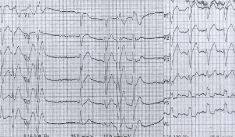Supraventricular Tachycardia Adenosine Treatment for SVT: The First Minute Case #1 Narrow QRS rhythm at 220 bpm, patient appears sedated, no palpable pulses Treatment: Adenosine Cardioversion Beta