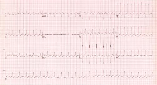 + ECG 14 SVT with ventricular rate
