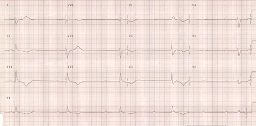 + ECG 16 Complete Heart Block Broad complex