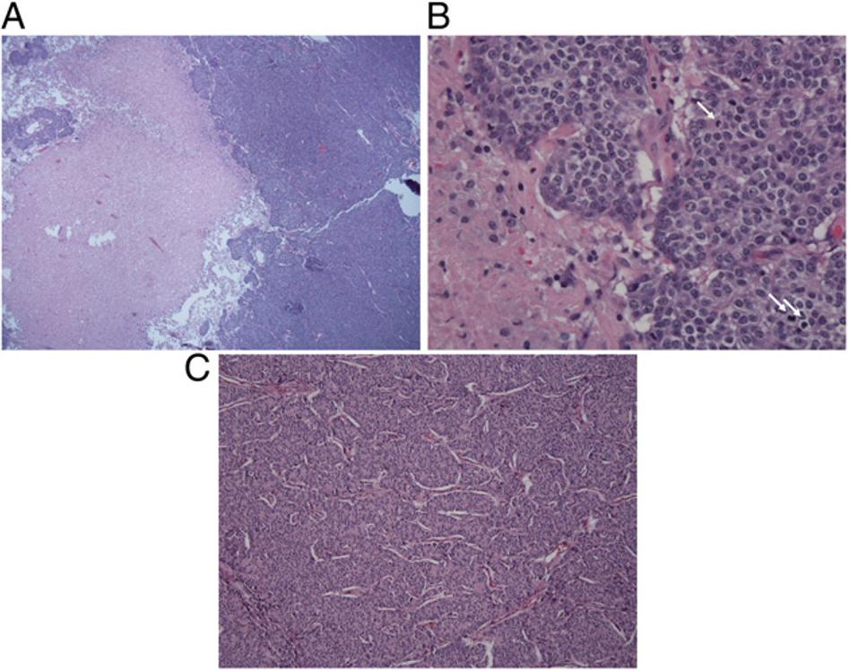 Figure 2 Tissue pathology. A, Well-circumscribed carcinoid tumor with area of necrosis (left) on low power (magnification 3 40).