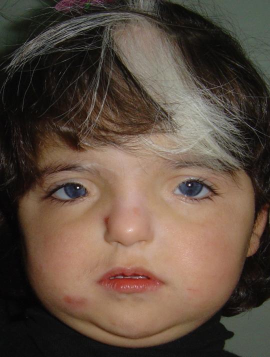 Wallerstein/Perinatal Genetics 6/3/2009 Waardenburg syndrome Originally described by Petrus Johannes Waardenburg in 1951 Main features cited: White forelock Broad nasal root Lateral