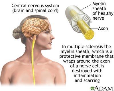 Multiple Sclerosis What is it?