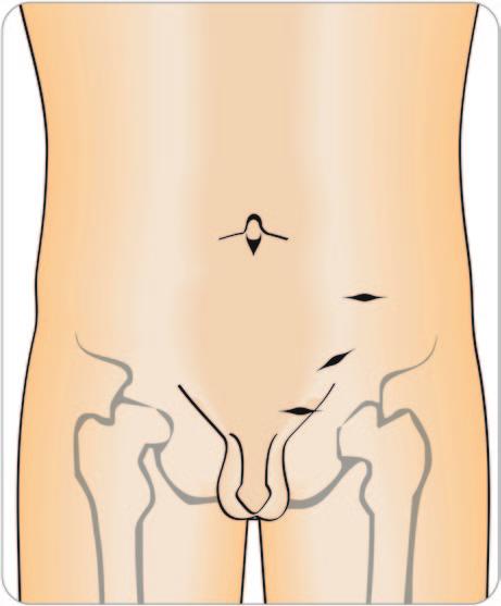 Surgical Treatment 51 Fig. 5.1 Incision sites used for subinguinal, inguinal and retroperitoneal open surgical varicocele repair.