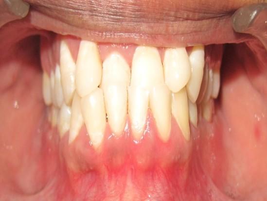 Case 3:- A 27 year old male reported with chief complain of backwardly placed upper front teeth.