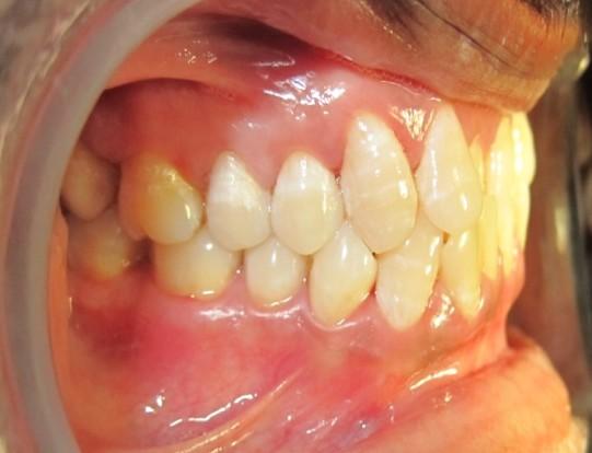 A concave profile, anterior crossbite with both central incisors & reverse overjet, class I molar relation