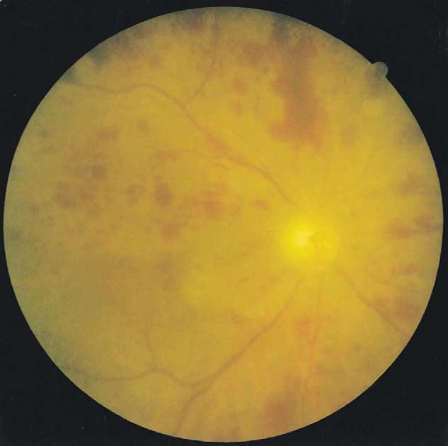 One week later, a whitish central retinal artery could be seen through the clear cornea, with visual acuity of hand motion in the right eye (Figure 4).
