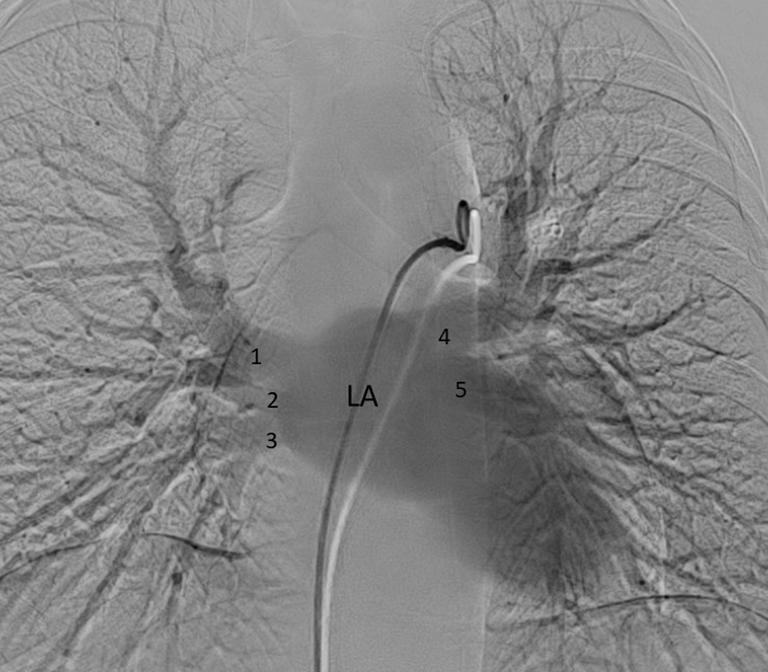 vein. Figure 3 Pulmonary venous anatomy on cardiac CT.