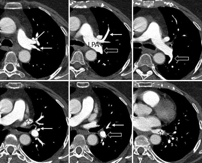 206 Kandathil and Chamarthy. Pulmonary vascular anatomy A B C D E F Figure 6 CT images demonstrating left pulmonary vascular anatomy.