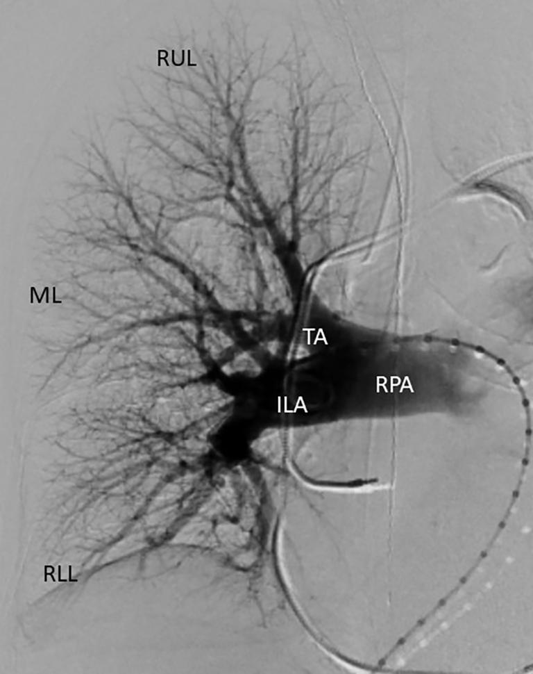 Left upper lobe (LUL) branches arise from the LPA ILA, interlobar arteries give rise to branches supplying the middle lobe (ML), lingula (L), right lower lobe (RLL) and left lower lobe (LLL).