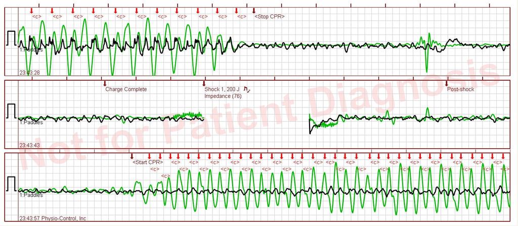 Pre & Post Shock Pauses 2 Pre-shock and post shock pauses lead to CPR interruptions 24 second