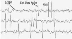 EMG correlation MEEP (miniature end plate potential): Initial deflection: negative Amplitude: 10 50 µv Rhythm: irregular Rate: high frequency (150 Hz) Endplate Spikes: Initial deflection: negative