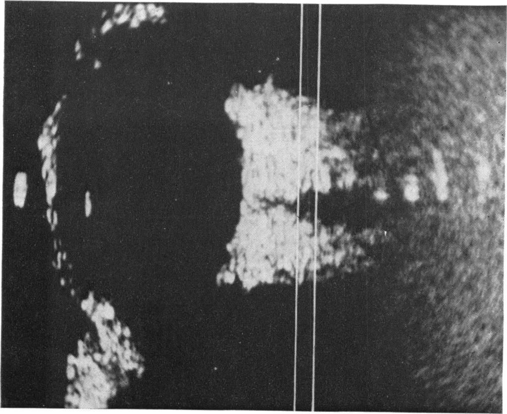 736 Marie Restori and John E. Wright Sagittal tumour, possibly by psammoma bodies which were 1B- scan plane demonstrated histologically. These echoes were not demonstrated on the B-scan display.