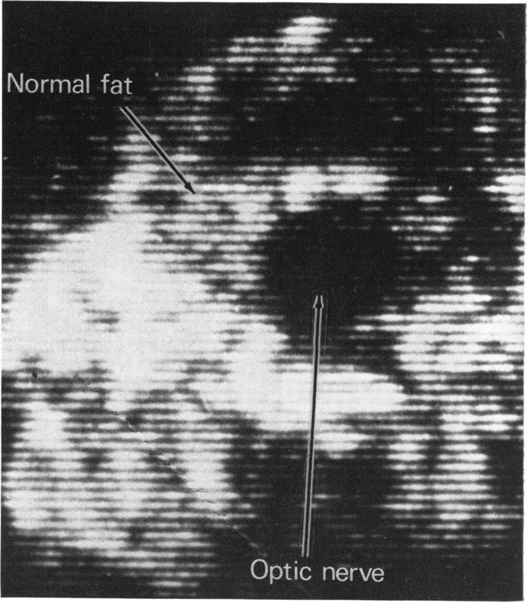optic nerve-c-scan Marie Restori and John E. Wright Fig.