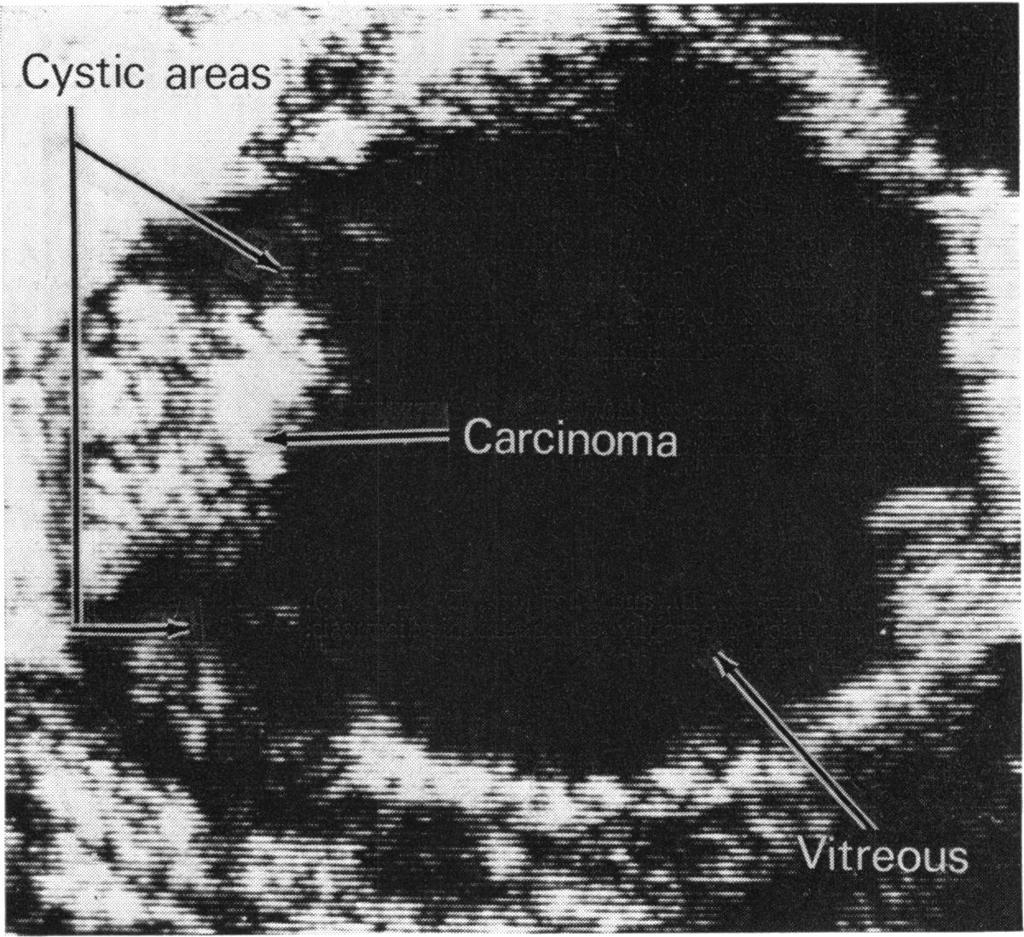 C-scan ultrasoniography in orbital diagnosis Fig. 8 Mass originating in the lacrimal gland shown in coronal C-scan plane ment was determined by means of consecutive C-scan sectioning of the orbit.