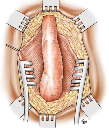 Translational Andrology and Urology, Vol 6, No 6 December 2017 1135 A B C Figure 3 Dorsal onlay buccal mucosal graft urethroplasty.