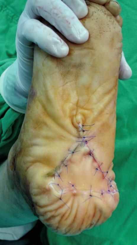 the fibrous septa and to easily move the flap depending on the subcutaneous random base was