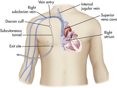 Centrally inserted catheters and implanted ports must be placed by a