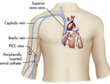 PICC PICCs are central venous catheters inserted into a vein in the arm and advanced to a position with the tip ending in the superior vena cava.