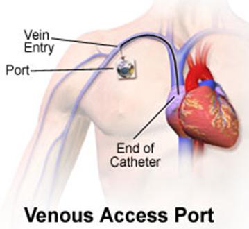 Implanted Port The catheter is placed into the desired vein and the other end is connected to a port that is surgically implanted in a subcutaneous pocket on the chest wall.