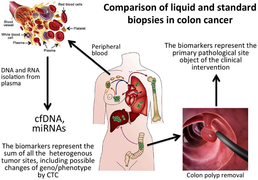 1412 FINOTTI et al: PCR-FREE ULTRASENSITIVE DETECTION SYSTEMS FOR LIQUID BIOPSY Figure 3. Comparison of liquid and standard conventional tissue biopsies in colorectal cancer (CRC).