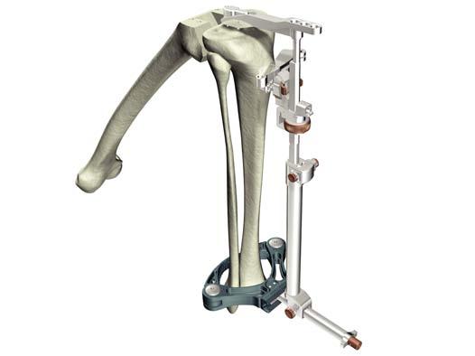 Option 1 Extramedullary Referencing Figure 1 > The tibial resection assembly has five parts: the appropriate Revision Tibial Resection Guide, the Ankle Clamp, the Distal Assembly, the Proximal Rod