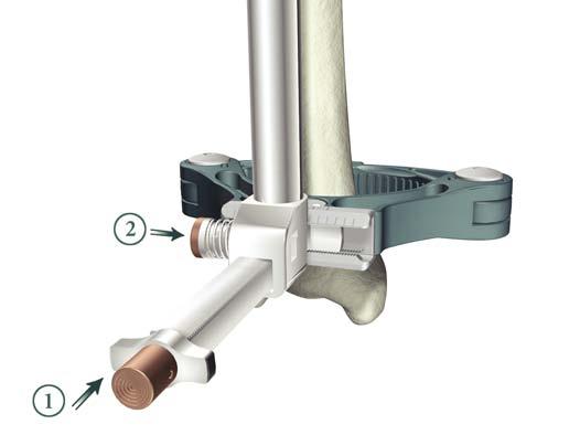 The 0 Tibial Adjustment Housing should always be used for preparing for the Universal Baseplate if a stem is indicated.
