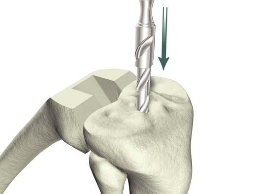 assembly is aligned with the center of the ankle.