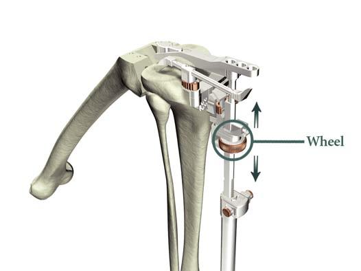 Instrument Bar Tibial Preparation Figure 9 [The following applies to both extramedullary and intramedullary alignment.