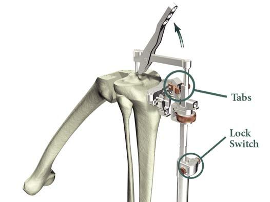 > Remove all alignment instruments leaving only the Revision Tibial Resection Guide in place.