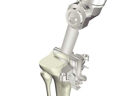 Instrument Bar 6543-2-702 Tibial Sagittal Resection Guide Tibial Preparation Figure 12 > If an additional 10mm tibial augment resection is required, remove the X pin and drop the resection guide down