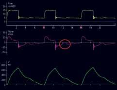 Late cycling Two mechanical s triggered by one single patient effort Mechanical prolonged during patient expiration Evident from patient observation Two s can be seen on the pressure or flow
