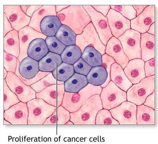 5 Cancer Cells: Growing Out of Control Cancer is a group of diseases characterized by uncontrolled cell proliferation - is a disease of the cell cycle. Kills one out of every 5 people in the U.S.