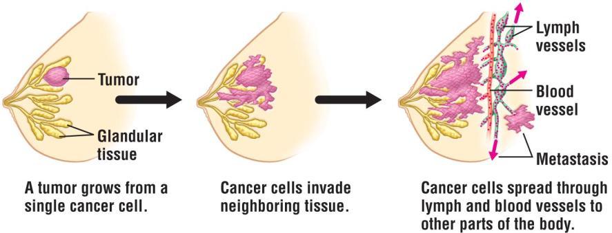 Malignant Tumor Cancer cells can form tumors (neoplasms), which are abnormal growths (masses) of body cells. Two types of Tumors: 1.