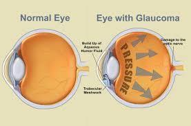 What research is being done? Through studies in the laboratory and with patients, NEI is seeking better ways to detect, treat, and prevent vision loss in people with glaucoma.