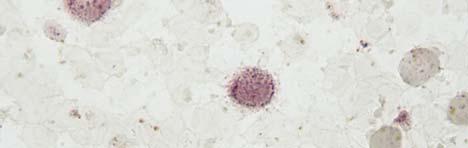 HCL phenotype: TRAP HCL phenotype: TRAP Tartrate-resistant acid phophatase (TRAP) by cytochemistry on smears: HCL strongly (+), but may be only in a few cells Not specific: some marginal zone