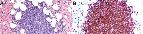 Composite mantle cell lymphoma and chronic lymphocytic