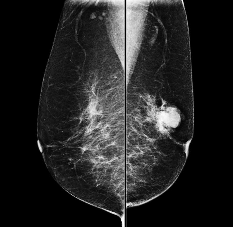 Percutaneous Ultrasound-Guided Vacuum-Assisted Removal as a Rebiopsy Method A B C Fig. 3. 77-year-old woman with palpable mass in her left breast. A. Left mediolateral oblique mammography view shows irregular shaped hyperdense mass.