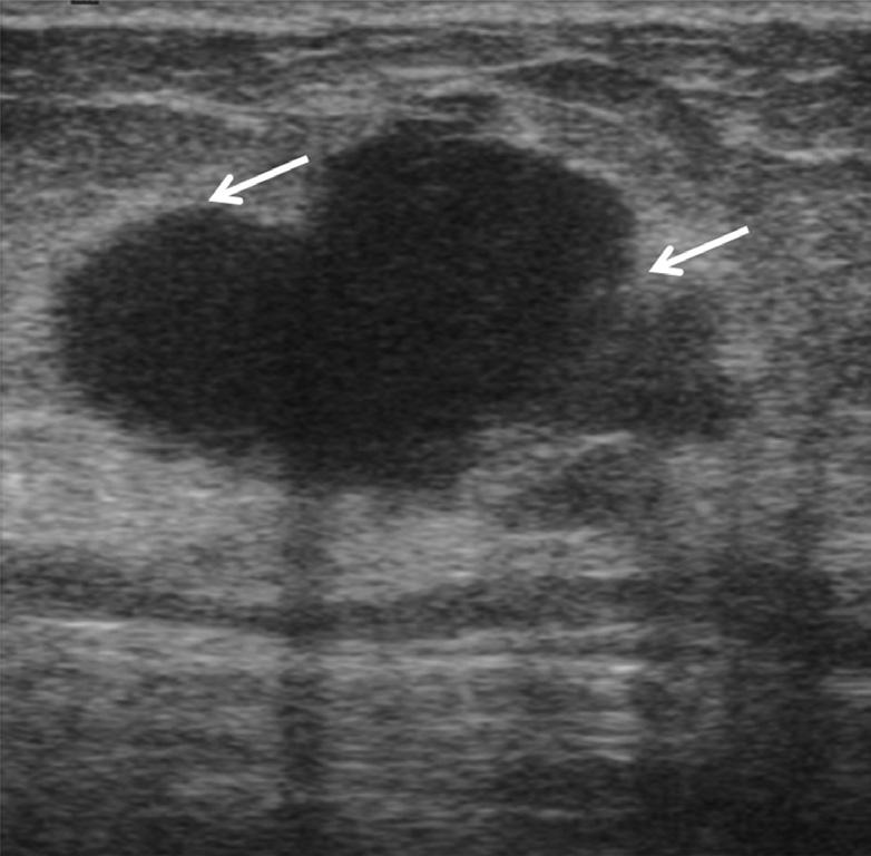 Ultrasound-guided core needle biopsy revealed intraductal papilloma; however, this result was regarded as discordant benign.