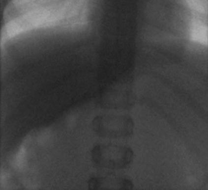 effect on duodenum May prevent contrast from passing to left of