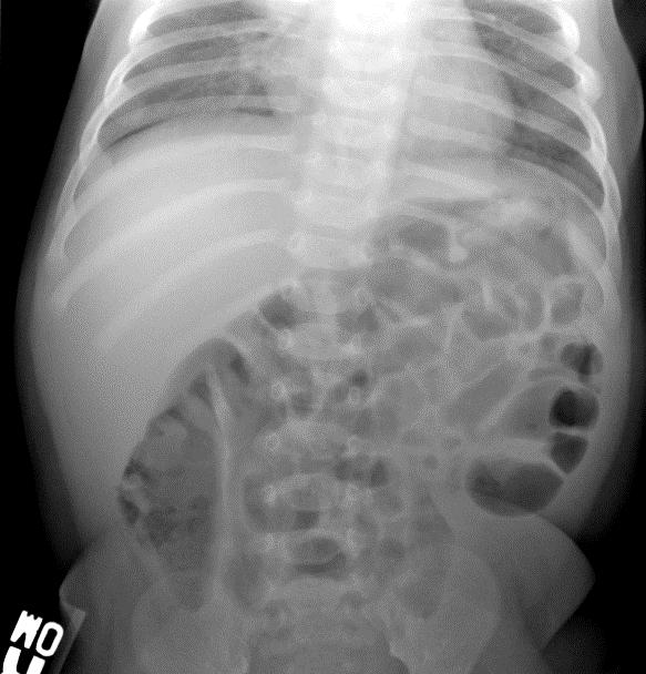 CASE 3 11 week old with nonbilious