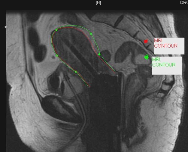 Image Based Brachytherapy in cervical Cancer TAUS and MRI correlation (TMH data) In collaboration with Peter Mac Melbourne
