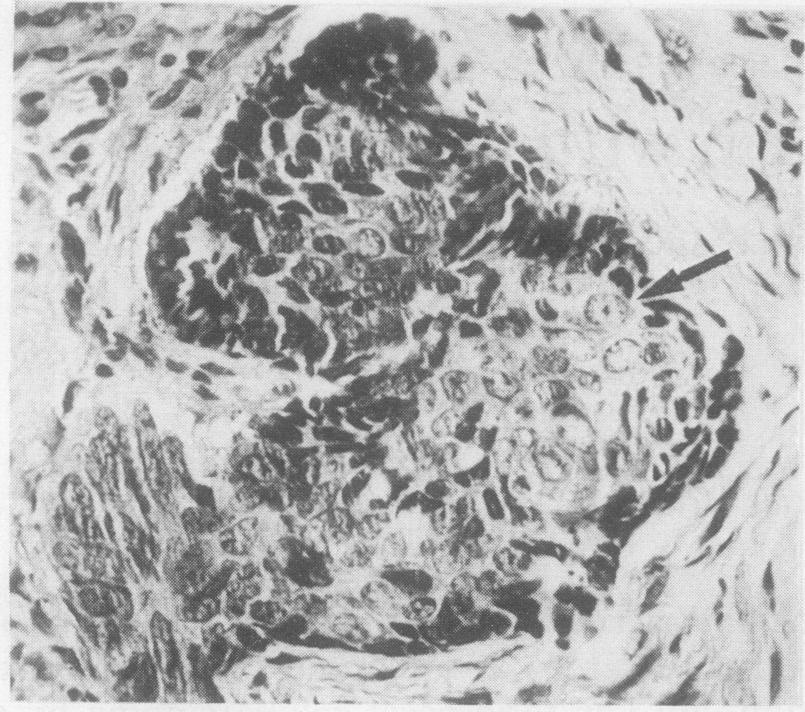 1274. _.4, 4., Fig. 1 Control patient with solid basal cell carcinoma. Cluster ofbasal cell carcinoma has cells with large vesicular nuclei (arrow) and spikey outline. (Hematoxylin and eosin.) x 300.