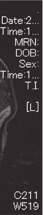 Figure 3: Bilateral multiple neck lymph