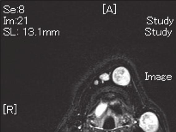 shows a  in the floor of mouth (Figure 2).