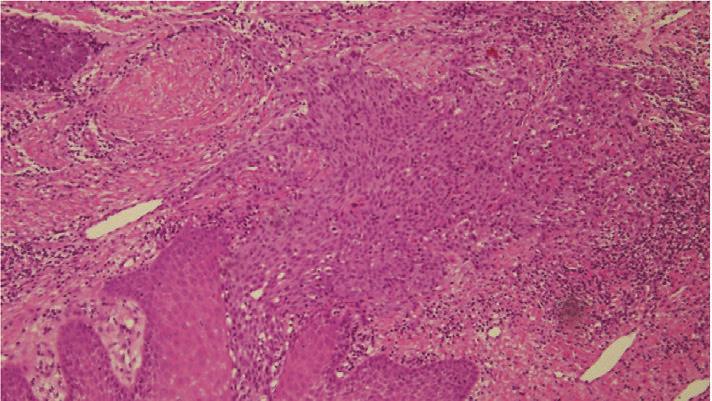 Nonkeratic dysplastic squamous cells proliferated with apoptosis and mitosis.