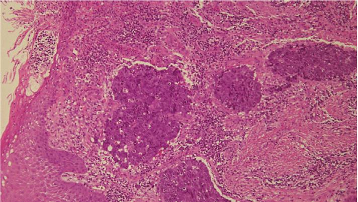 Microscopically, the tumor consisted of two components of SCC and AC.